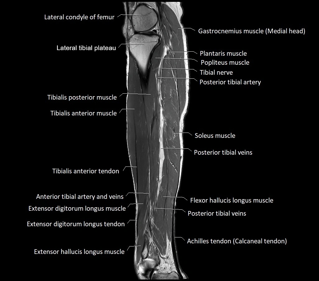 Lower leg sagittal anatomy 3T MRI image 15.webp